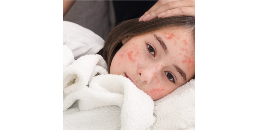 If You Have to Get Sick, You Sure Can’t beat the Measles!