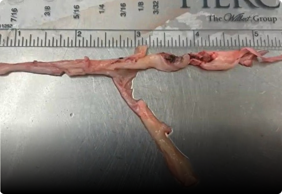 5+ Inch Clot Found During Autopsy