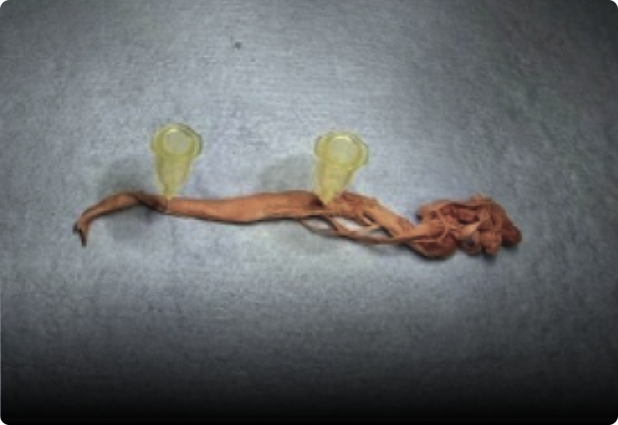 Calamari Clots Gross Anatomy