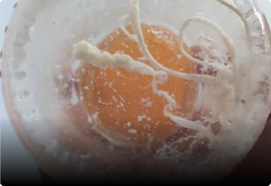Rubbery Clot Found By Embalmer
