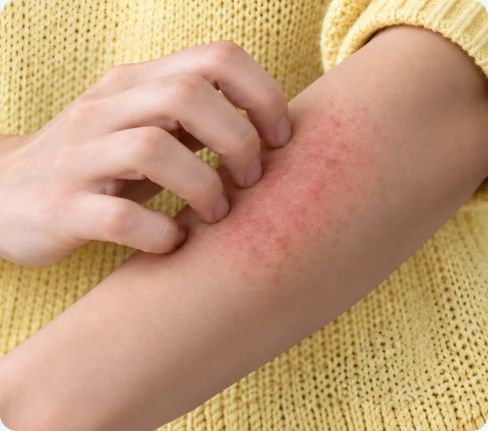 Allergy symptoms and itching
